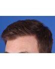 After Hair Transplant&nbsp;Front